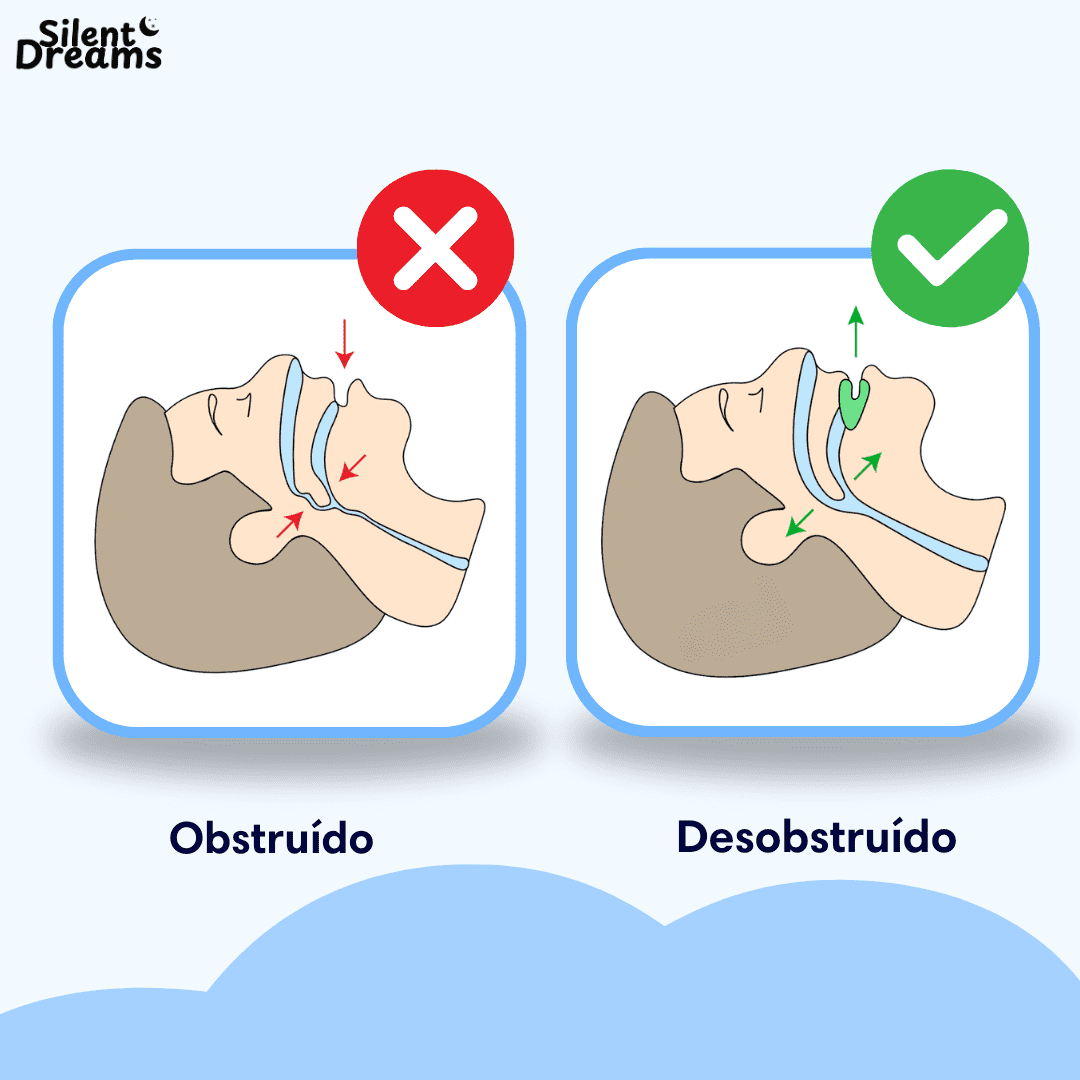 Anti ronco, aparelho para parar de roncar